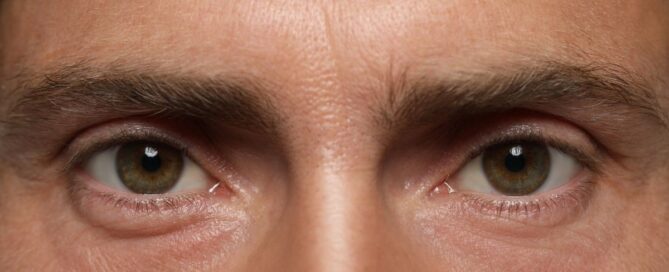 Male patient after brow lift for men in Northern Virginia showing improved brow position and reduced forehead heaviness